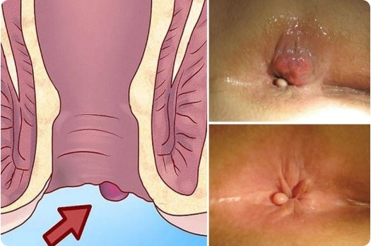 Bệnh trĩ – Hiểu đúng, chữa đúng để không còn ám ảnh