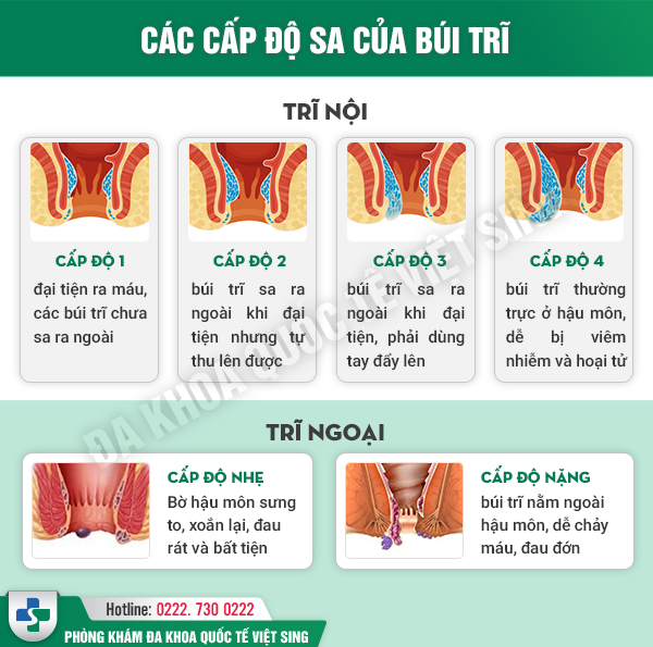 Chuyên gia chia sẻ tất tần tật thông tin về bệnh trĩ nội – Hiểu đúng để khám chữa hiệu quả