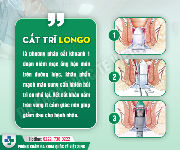 Bác sĩ Lê Văn Hốt phân tích: Cắt trĩ bằng Longo có thực sự là lựa chọn tối ưu?