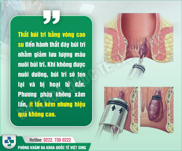 Thắt búi trĩ: Giải pháp “cũ” nhiều rủi ro mà người bệnh cần cân nhắc